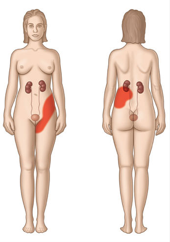 dolrointensocalculosurinarios